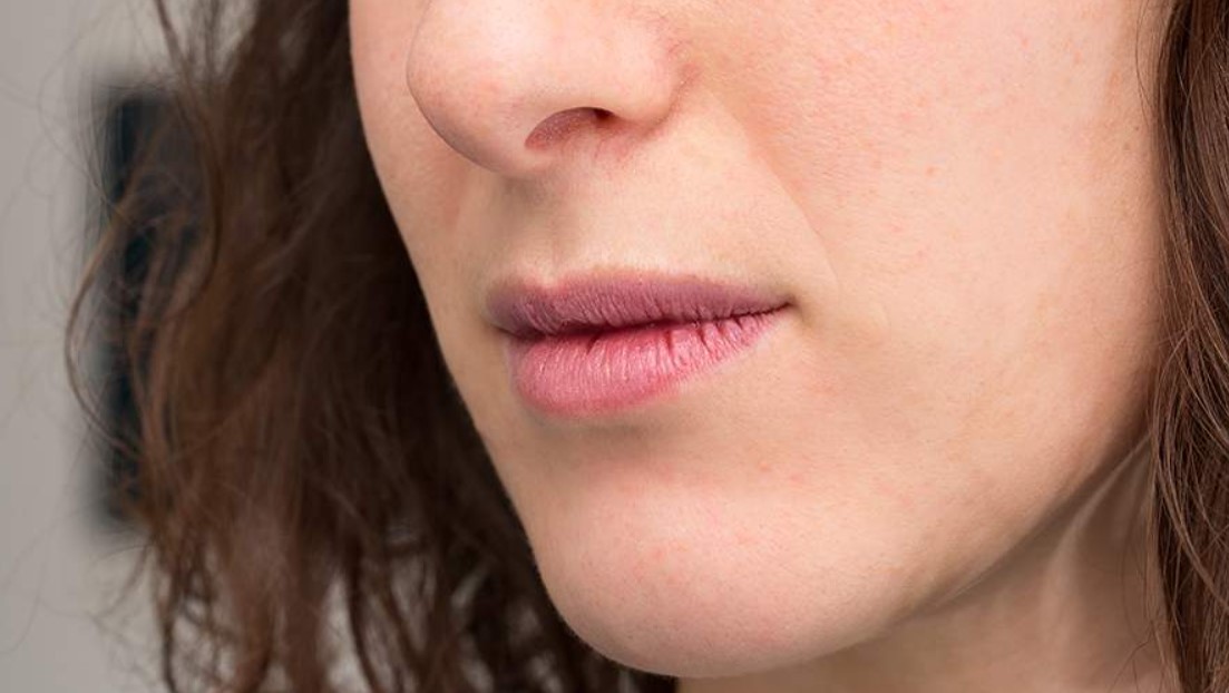 Врач назвала трещинки в уголках губ симптомом опасного заболевания