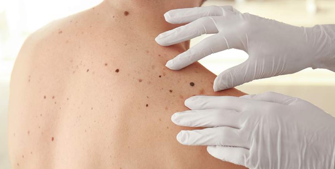 Врач перечислила признаки рака кожи. Читайте на UKR.NET