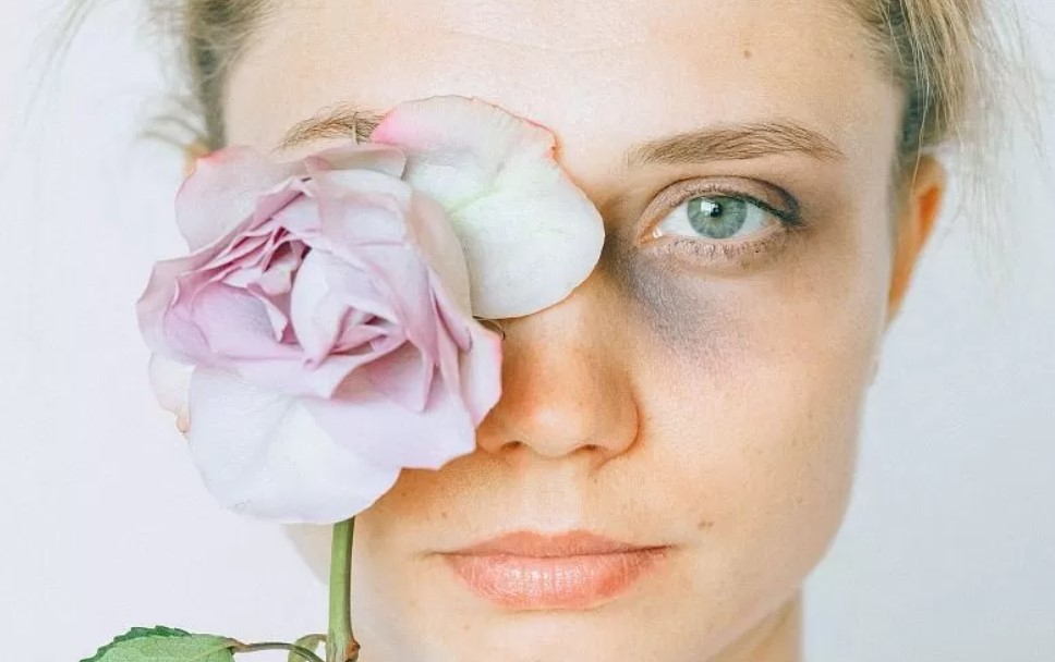 Как быстро убрать синяки в домашних условиях