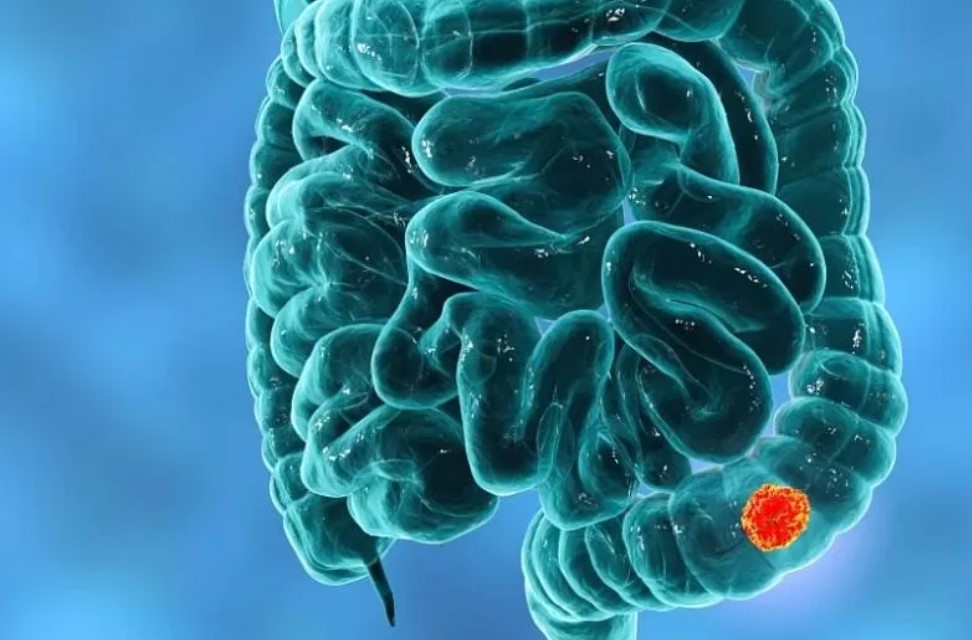 Пять симптомов, которые предупреждают вас о раке кишечника