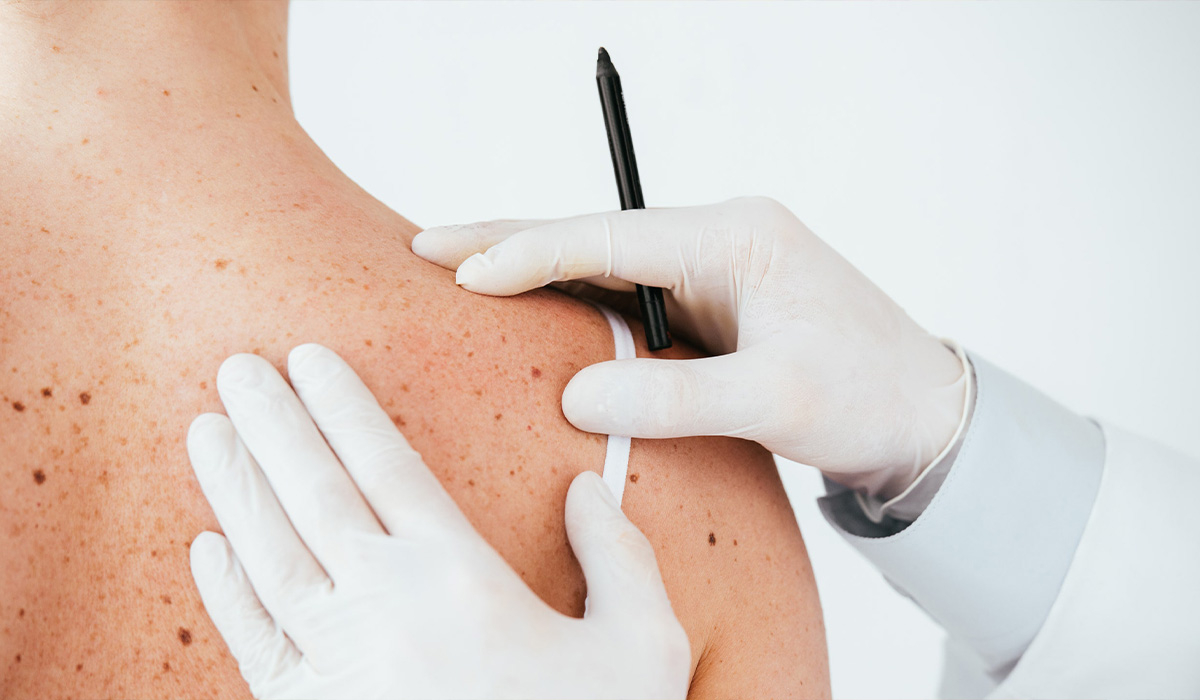 Рак кожи: как выявить и предотвратить опасное заболевание