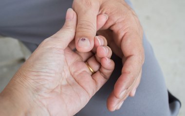 Прихована загроза: медики розповіли про симптом підвищеного холестерину