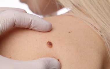 Лікар Калакутська: які папіломи вказують на онкозахворювання