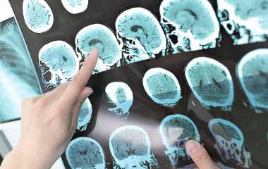 Медики назвали перші симптоми хвороби Альцгеймера
