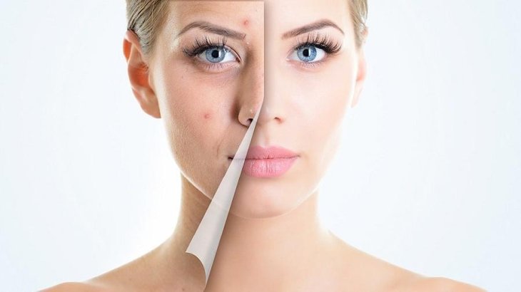 4 пищевых привычки, которые помогут убрать прыщи