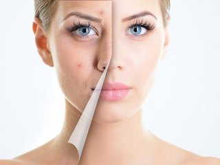 4 пищевых привычки, которые помогут убрать прыщи