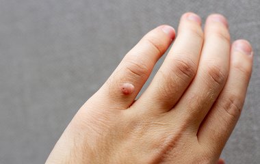 Папіломавірус людини може викликати рак простати