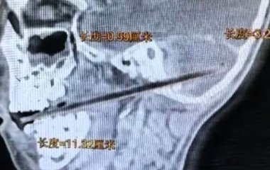 Паличка від льодяника застрягла в мозку 6-річного хлопчика: як це сталося і закінчилося (фото)