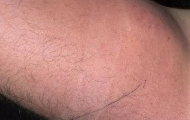 Хотів вилікувати спину власною спермою: дивний експеримент чоловіка закінчився лікарнею