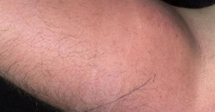 Хотів вилікувати спину власною спермою: дивний експеримент чоловіка закінчився лікарнею