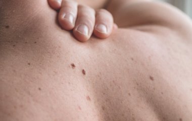 Як самому визначити злоякісну родимку