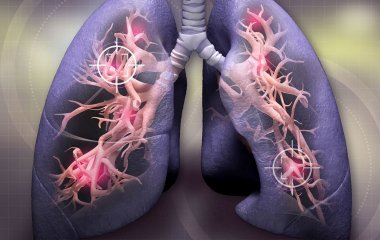 Британські медики назвали «шкірні» симптоми раку легень
