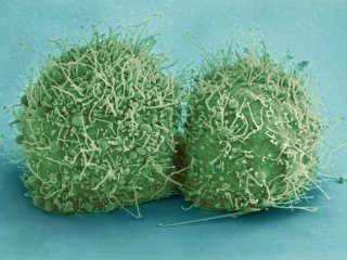 Медики назвали неожиданные факторы, которые могут спровоцировать рак