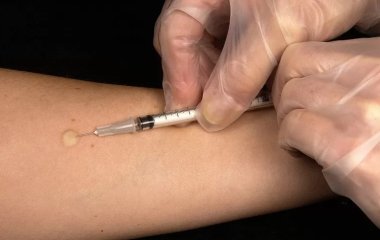 Легенева патологія: найпопулярніші міфи про туберкульоз