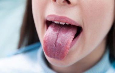 Медики розповіли, яку смертельну небезпеку можуть вказувати плями мовою