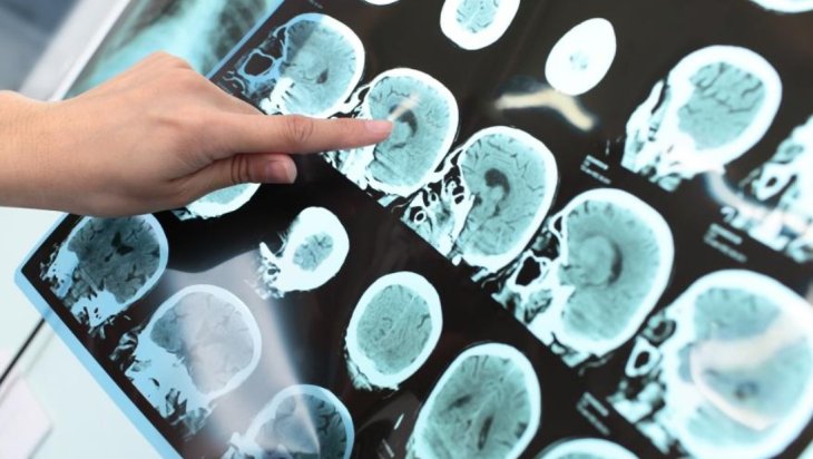 Вчені виявили ще одну небезпеку алкоголю