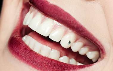 Скайсы – украшение на зубах