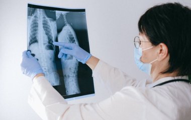 Лікар назвала несподівані симптоми, що свідчать про рак легень