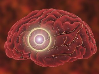 Що робити для профілактики інсульту: поради вчених