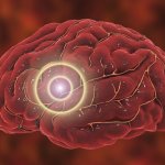 Что делать для профилактики инсульта: советы ученых