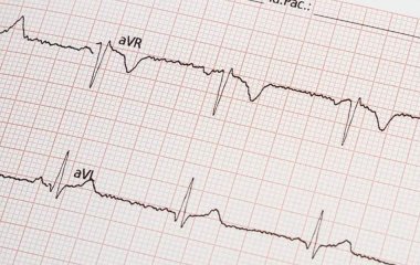 Терапевт назвала нетипову ознаку інфаркту міокарда