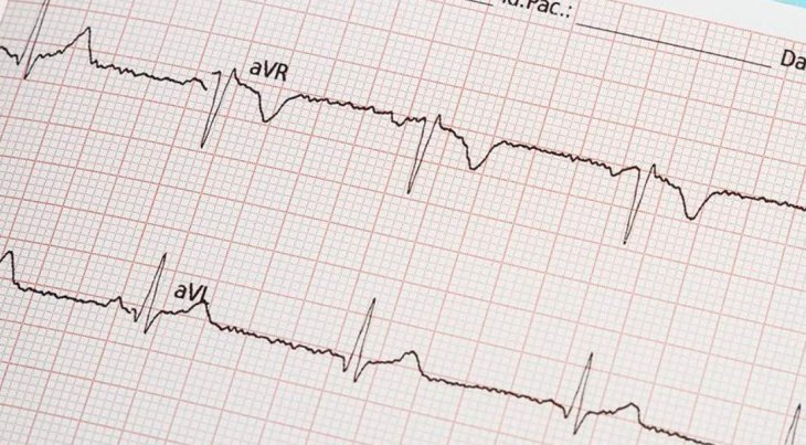 Терапевт назвала нетипичный признак инфаркта миокарда