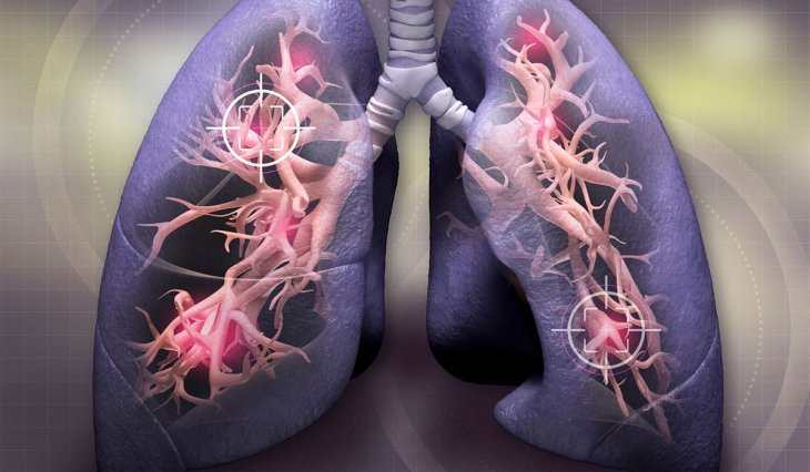 Медики назвали несподівані симптоми раку легень
