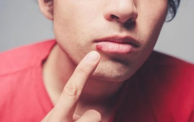 Почему на губах появляется простуда и чем ее лечить: запомните на всю жизнь