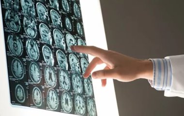 Лікар розповів, хто ризикує захворіти на розсіяний склероз.