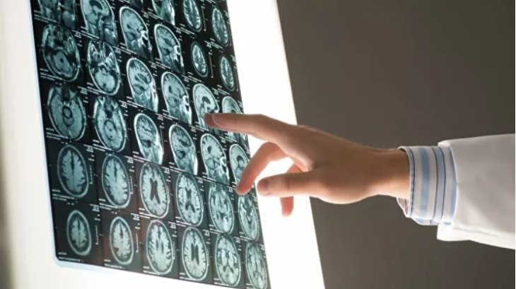 Лікар розповів, хто ризикує захворіти на розсіяний склероз.