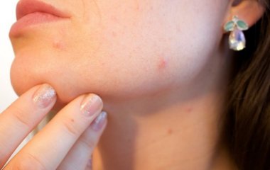 Лікарі розповіли, чому небезпечно тиснути прищі