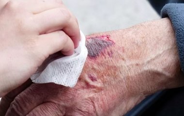 Лікар радить, як лікувати опіки в домашніх умовах у дітей та дорослих
