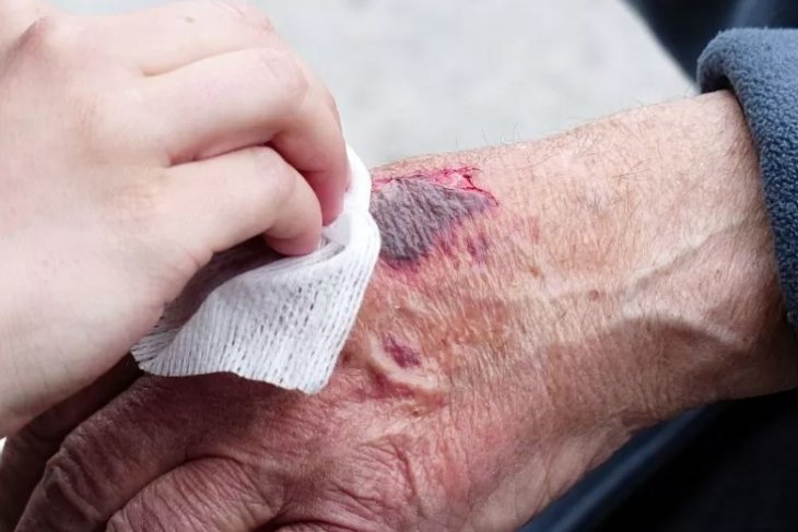 Лікар радить, як лікувати опіки в домашніх умовах у дітей та дорослих