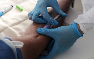 Невролог назвала ризики для організму за високого рівня холестерину в крові