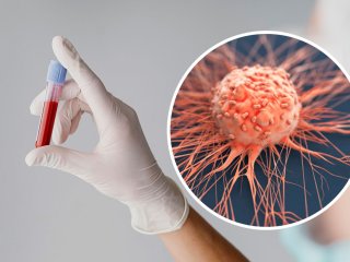 Стало відомо, люди якої групи крові найбільше схильні до раку