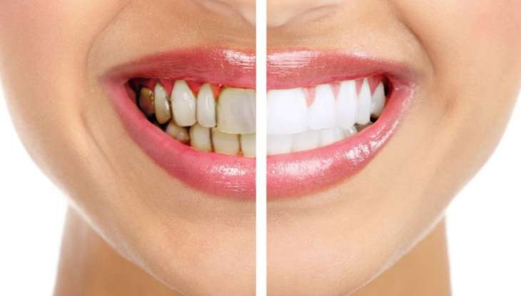 Чистка зубов: почему не обойтись без стоматологов?