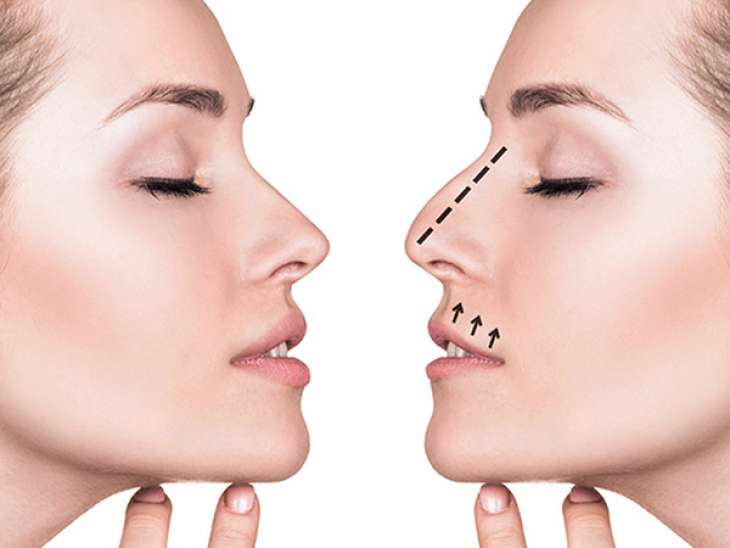 Ринопластика: современный способ исправления дефектов носа