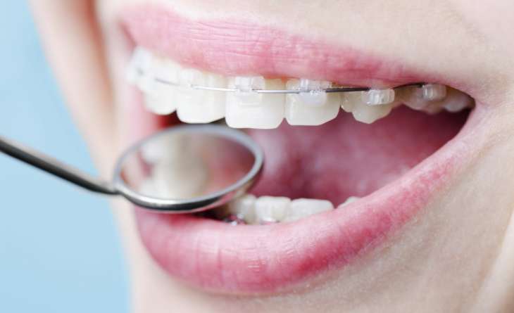 Установка брекетов – эффективный способ исправления неправильного зубного прикуса