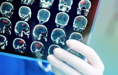 Невролог назвала які дозволяють виявити інсульт способи