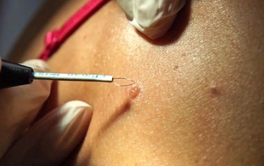 Как удалить родинки в Киеве: Советы и варианты лечения