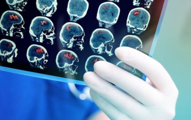 Лікар розповів про небезпечні наслідки струсу мозку