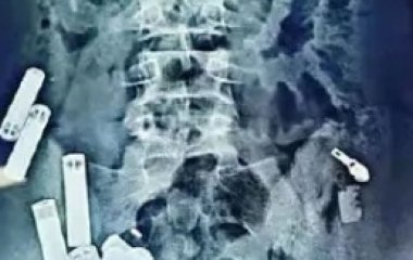 15-річний хлопчик помер після того, як хірурги дістали з його тіла 56 металевих предметів – фото