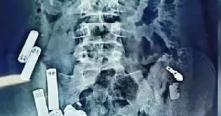 15-річний хлопчик помер після того, як хірурги дістали з його тіла 56 металевих предметів – фото
