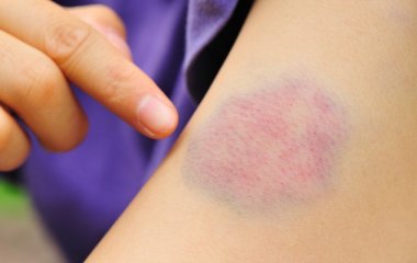 З'явився синець, хоч удару не було? Або з'їли не те чи терміново до лікаря!