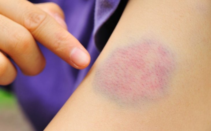 З'явився синець, хоч удару не було? Або з'їли не те чи терміново до лікаря!