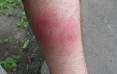 Чому чухати укус комахи шкідливо — буде тільки гірше