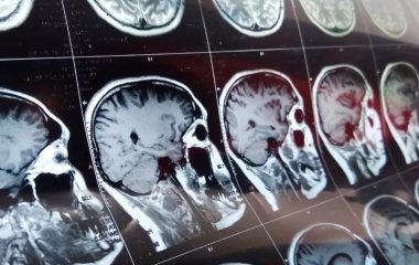 Лікар назвав дві найяскравіші ознаки інсульту