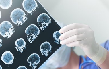 Вчені знайшли спосіб контролювати епілептичні напади