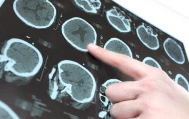Невролог перерахувала симптоми інсульту віком до 45 років