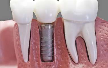 Зубные импланты: сколько стоить поставить имплант?